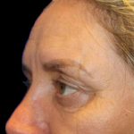 Blepharoplasty Before & After Patient #1449