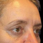 Blepharoplasty Before & After Patient #1449