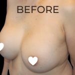 Breast Augmentation (Revision) Before & After Patient #591