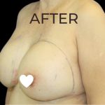 Breast Augmentation (Revision) Before & After Patient #591