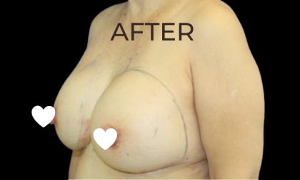 Breast Augmentation (Revision) Before & After Patient #591