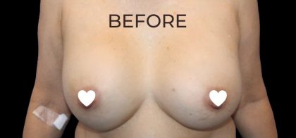 Breast Augmentation (Revision) Before & After Patient #591