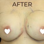Breast Augmentation (Revision) Before & After Patient #591