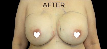 Breast Augmentation (Revision) Before & After Patient #591