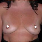 Breast Augmentation (Saline) Before & After Patient #469