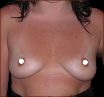 Breast Augmentation (Saline) Before & After Patient #469