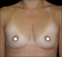 Breast Augmentation (Saline) Before & After Patient #470