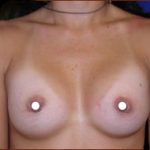 Breast Augmentation (Saline) Before & After Patient #470