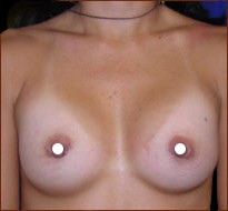 Breast Augmentation (Saline) Before & After Patient #470