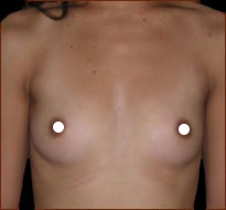 Breast Augmentation (Saline) Before & After Patient #472