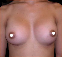 Breast Augmentation (Saline) Before & After Patient #472