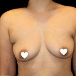 Breast Augmentation (Silicone) Before & After Patient #567
