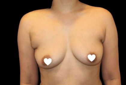 Breast Augmentation (Silicone) Before & After Patient #567