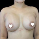 Breast Augmentation (Silicone) Before & After Patient #567