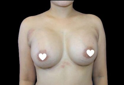Breast Augmentation (Silicone) Before & After Patient #567