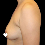 Breast Augmentation (Silicone) Before & After Patient #567