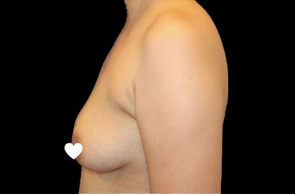 Breast Augmentation (Silicone) Before & After Patient #567