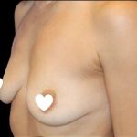 Breast Augmentation (Silicone) Before & After Patient #567