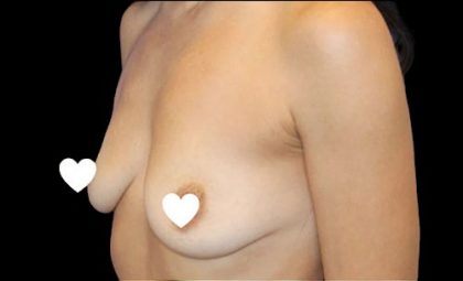 Breast Augmentation (Silicone) Before & After Patient #567
