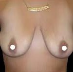 Breast Augmentation (Silicone) Before & After Patient #583