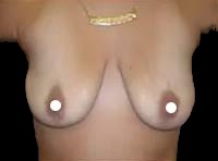 Breast Augmentation (Silicone) Before & After Patient #583