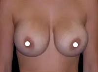 Breast Augmentation (Silicone) Before & After Patient #583