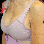 Dermal Fillers Before & After Patient #1174