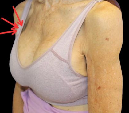 Dermal Fillers Before & After Patient #1174
