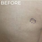 Dermal Fillers Before & After Patient #1175