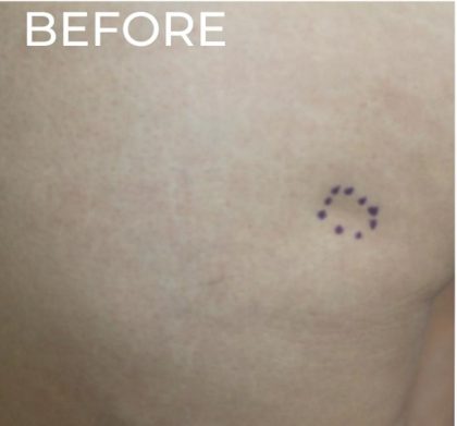 Dermal Fillers Before & After Patient #1175