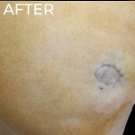 Dermal Fillers Before & After Patient #1175