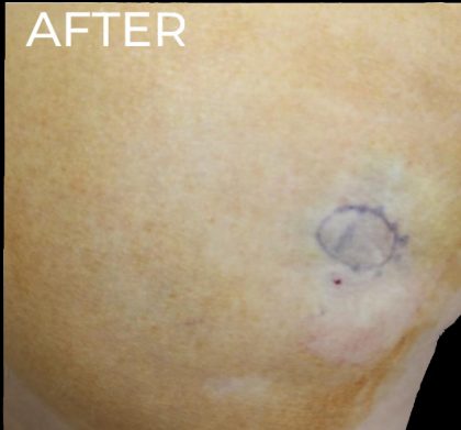 Dermal Fillers Before & After Patient #1175