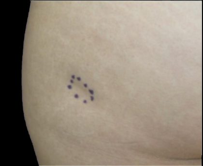 Dermal Fillers Before & After Patient #1175