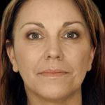 Dermal Fillers Before & After Patient #1181