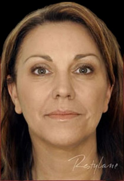 Dermal Fillers Before & After Patient #1181