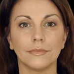 Dermal Fillers Before & After Patient #1181