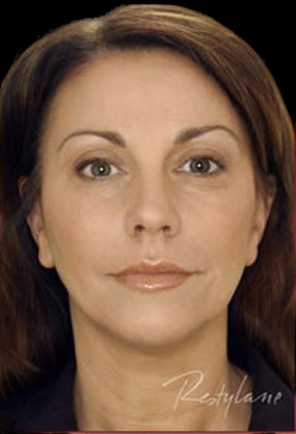 Dermal Fillers Before & After Patient #1181