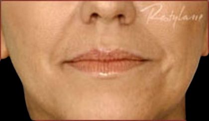 Dermal Fillers Before & After Patient #1182