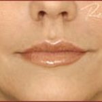 Dermal Fillers Before & After Patient #1182