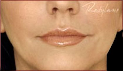 Dermal Fillers Before & After Patient #1182