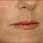 Dermal Fillers Before & After Patient #1183