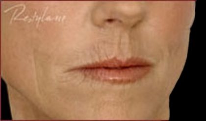 Dermal Fillers Before & After Patient #1183