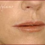 Dermal Fillers Before & After Patient #1183