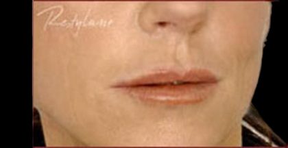 Dermal Fillers Before & After Patient #1183