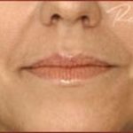 Dermal Fillers Before & After Patient #1185