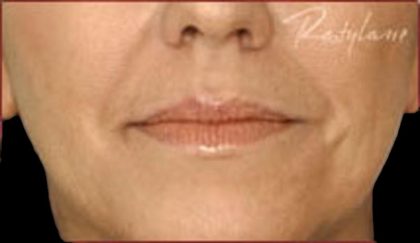 Dermal Fillers Before & After Patient #1185