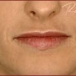 Dermal Fillers Before & After Patient #1185