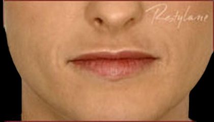 Dermal Fillers Before & After Patient #1185