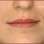Dermal Fillers Before & After Patient #1186