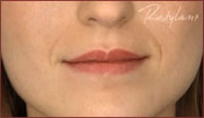 Dermal Fillers Before & After Patient #1186